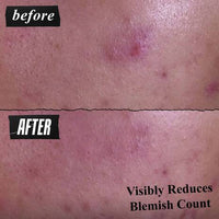 Kiehl's - Gently Effective Blemish-Treating Facial Cleansing Paste