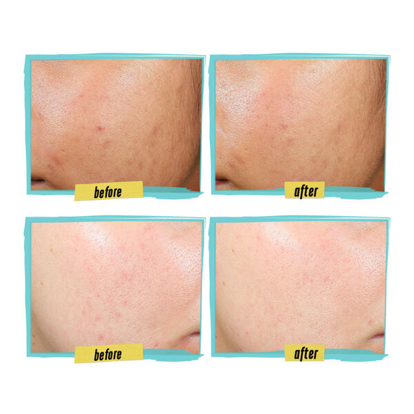 Kiehl's - Expertly Clear Blemish-Treating & Preventing Lotion