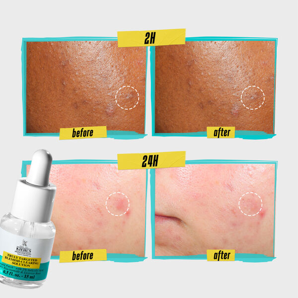Kiehl's - Truly Targeted Blemish Clearing Solution-Parfumerie Olara-1
