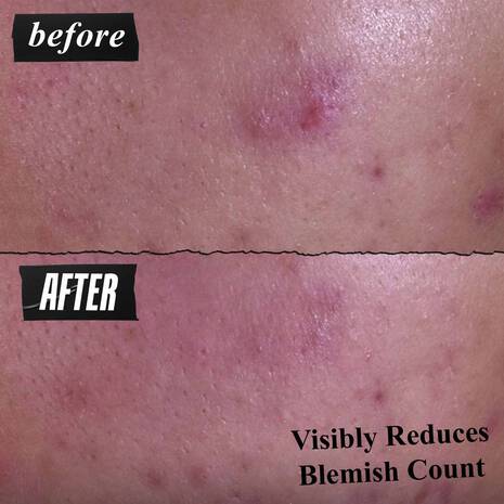 Kiehl’s - Gently Effective Blemish-Treating Facial Cleansing Paste